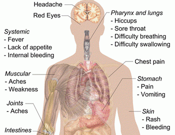 Ebola symptons